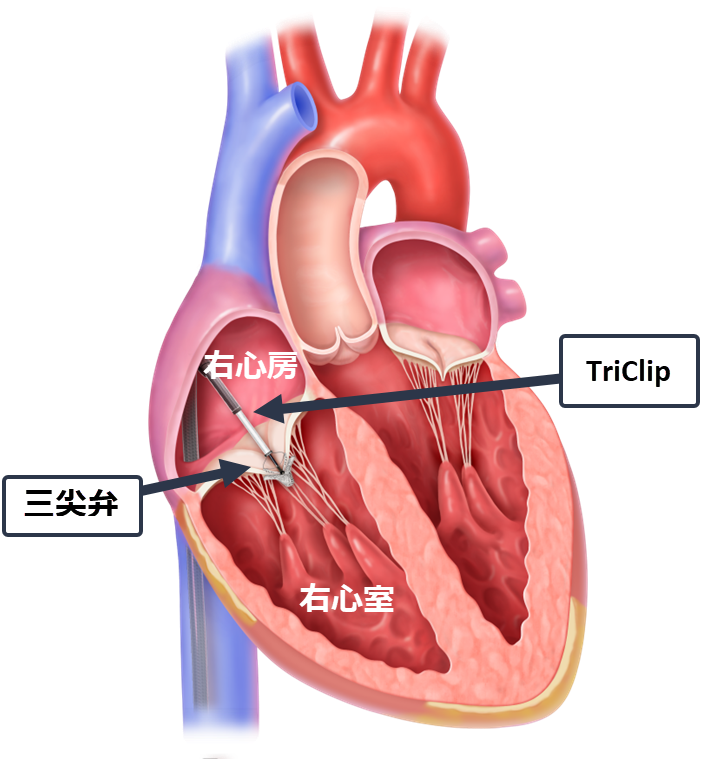 Triclip